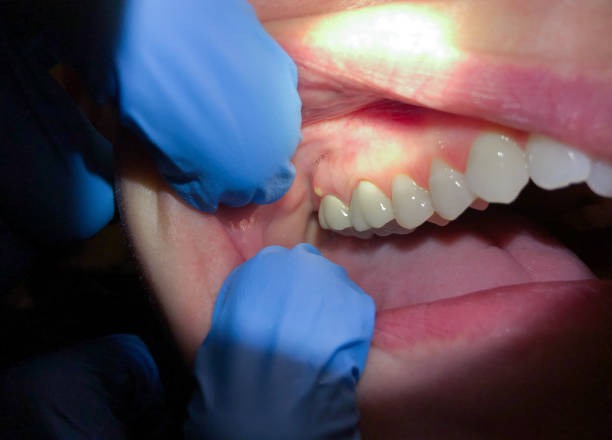 Best Teeth Whitening  in Eunice, LA
